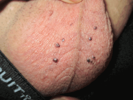 red bump on testicle sack
